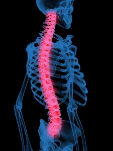 Spinal Cord Injury Lawyers 317-881-2700